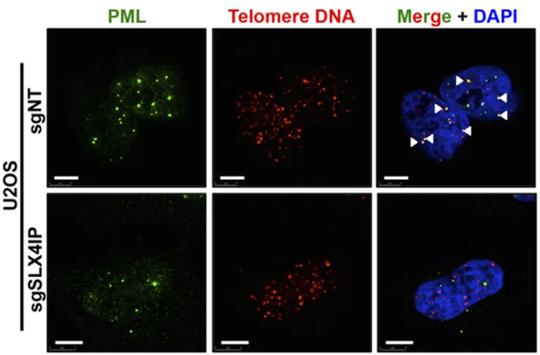 Figure from: SLX4IP and telomere dynamics dictate breast cancer metastasis and therapeutic responsiveness